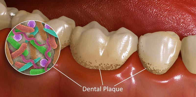 Zubni kamenac 1